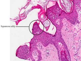 PA verruca seborroica