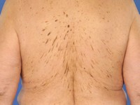 Verruca seborroica in dennenboom configuratie