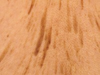 Verruca seborroica in dennenboom configuratie