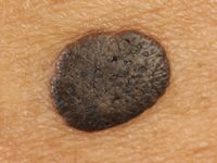 Melanoacanthoma (gepigmenteerde verruca seborroica)