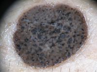 Melanoacanthoma (gepigmenteerde verruca seborroica)