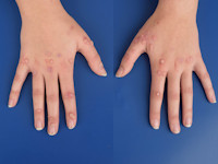 Hand warts, verruca vulgaris