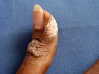 Handwratten, verruca vulgaris