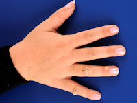 Hand warts, verruca vulgaris