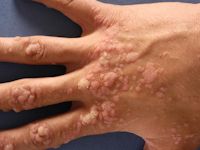 Hand warts, verruca vulgaris