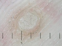 Hand warts, verruca vulgaris