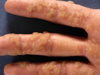 Handwratten, verruca vulgaris