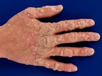 Handwratten, verruca vulgaris