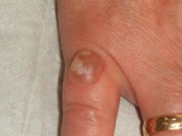 Wart after freezing with nitrogen