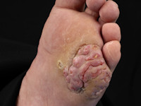 Verruceus carcinoom van de voetzool