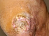 Verruceus carcinoom van de hiel