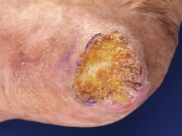 Verruceus carcinoom van de hiel