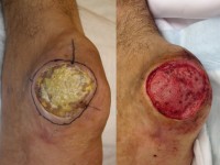 Verruceus carcinoom van de hiel