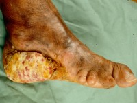 Verruceus carcinoom bij neuropathische voet