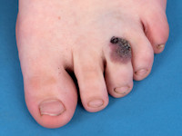 Verruceus hemangioom