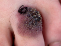 Verruceus hemangioom