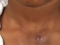 Vierde kieuwboog cyste