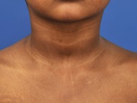 Vierde kieuwboog cyste