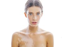 Vitiligo