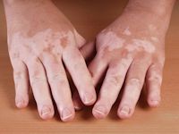 Vitiligo