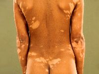 Vitiligo