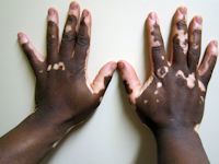 Vitiligo
