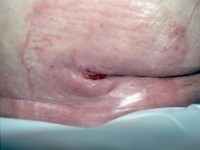 vochtletsel (incontinentie gerelateerde dermatose) met centraal daarin een graad 3 decubitus