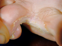 Athlete's foot (tinea pedis)