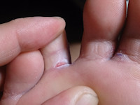 Voetschimmel (tinea pedis)