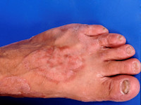 Athlete's foot (tinea pedis)