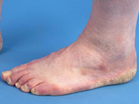 Voetschimmel (tinea pedis)