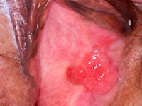 Plaveiselcelcarcinoom van de vulva