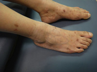 Macroglobulinemie van Waldenström