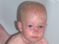 Chickenpox (Varicella)