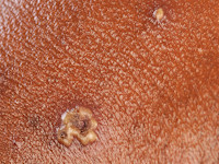 Waterpokken (Varicella)