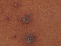 Chickenpox (Varicella)