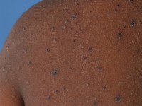 Chickenpox (Varicella)