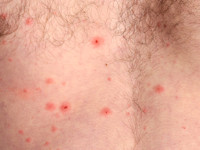 Waterpokken (Varicella)