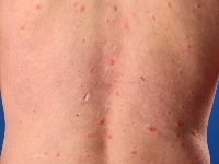 Chickenpox (Varicella)