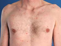 Chickenpox (Varicella)