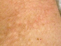 White fibrous papulosis of the neck