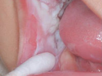 White sponge nevus, naevus spongiosus albus mucosae