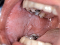 White sponge nevus, naevus spongiosus albus mucosae