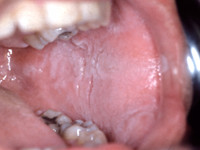 White sponge nevus, naevus spongiosus albus mucosae