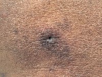 Winer's dilated pore