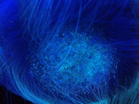 Tinea capitis onder de Wood's lamp