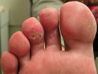 Foot warts, treatment with electrocoagulation