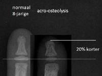Acro-osteolysis