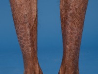 X-gebonden recessieve ichthyosis vulgaris