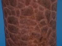 X-gebonden recessieve ichthyosis vulgaris